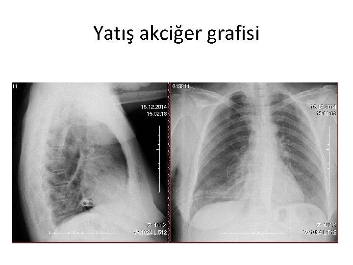 Yatış akciğer grafisi 