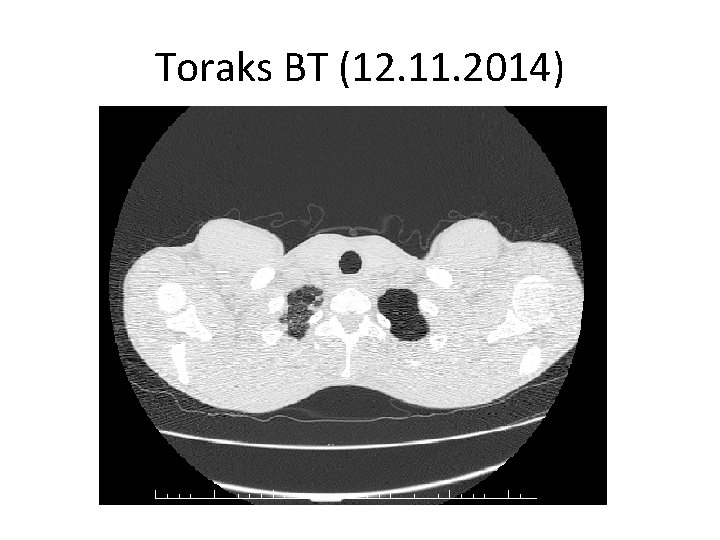 Toraks BT (12. 11. 2014) 