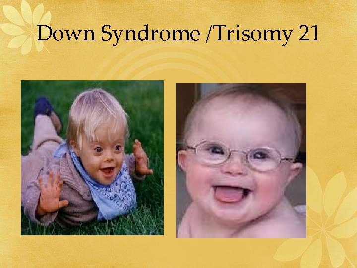 Down Syndrome /Trisomy 21 