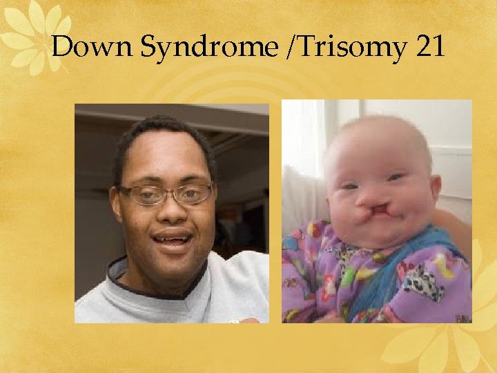 Down Syndrome /Trisomy 21 