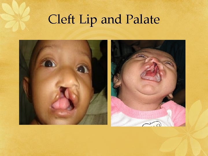 Cleft Lip and Palate 