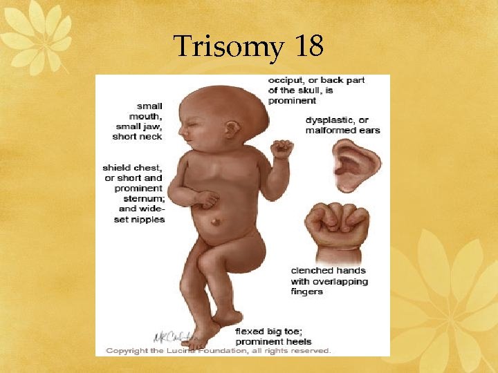 Trisomy 18 