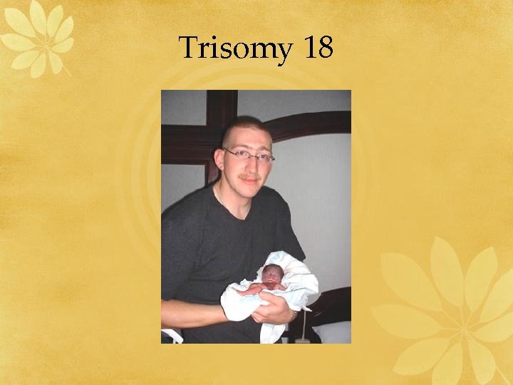 Trisomy 18 