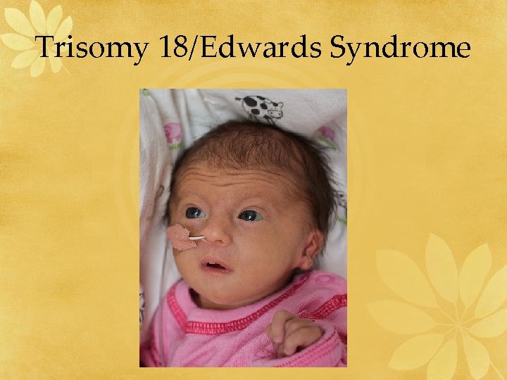 Trisomy 18/Edwards Syndrome 