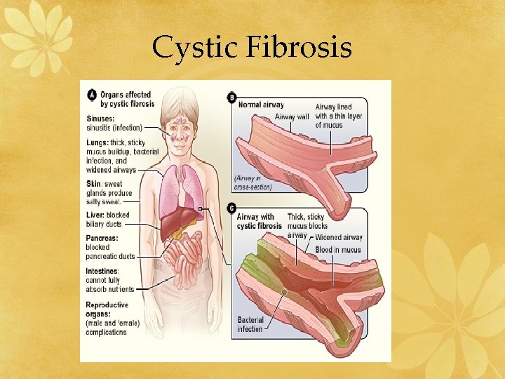 Cystic Fibrosis 