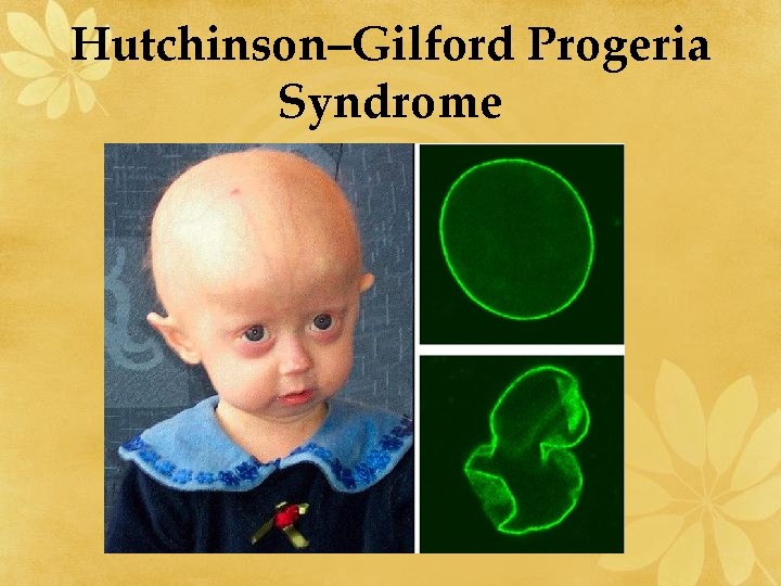 Hutchinson–Gilford Progeria Syndrome 