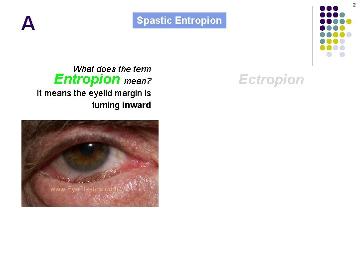 2 A Spastic Entropion What does the term Entropion mean? It means the eyelid