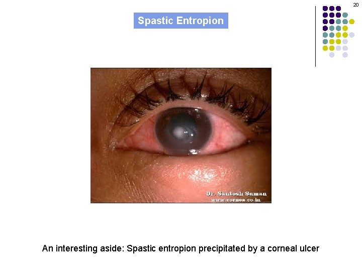 20 Spastic Entropion An interesting aside: Spastic entropion precipitated by a corneal ulcer 