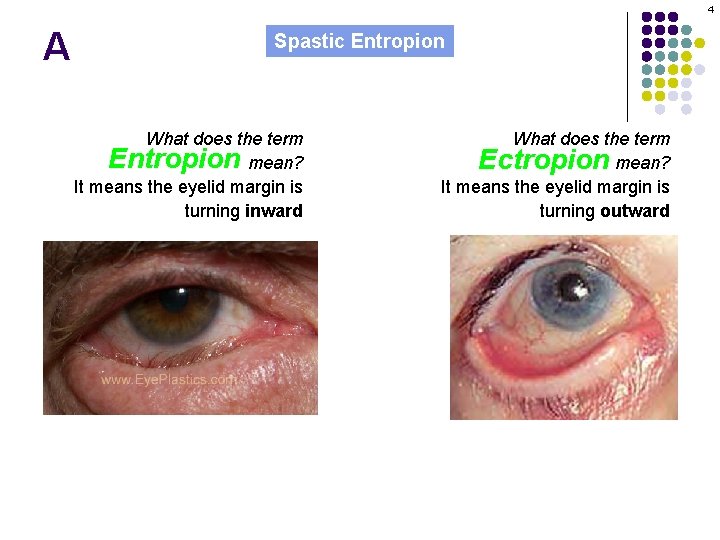 4 A Spastic Entropion What does the term Entropion mean? It means the eyelid
