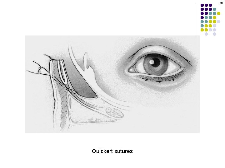 46 Quickert sutures 
