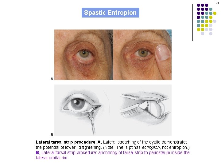 71 Spastic Entropion Lateral tarsal strip procedure. A, Lateral stretching of the eyelid demonstrates