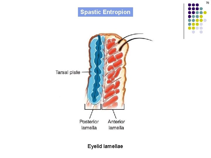 78 Spastic Entropion Eyelid lamellae 