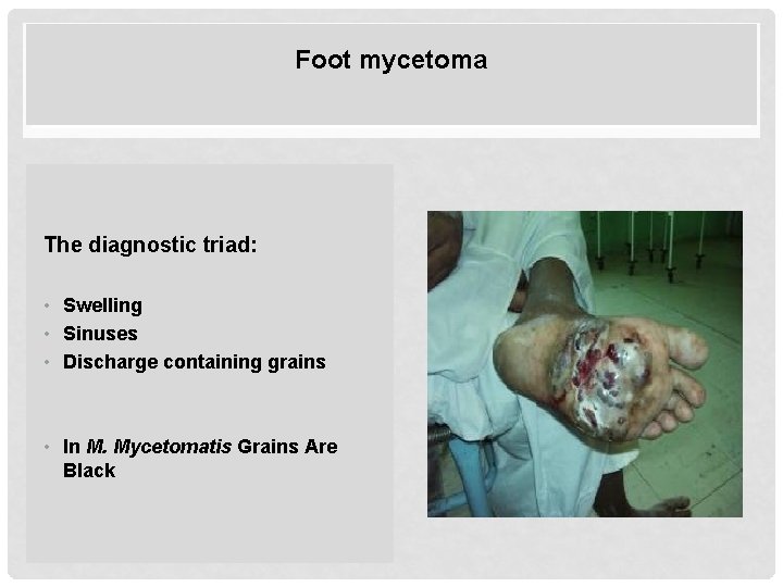 Foot mycetoma The diagnostic triad: • Swelling • Sinuses • Discharge containing grains •