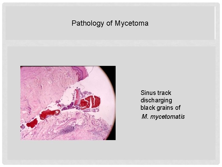 Pathology of Mycetoma Sinus track discharging black grains of M. mycetomatis 