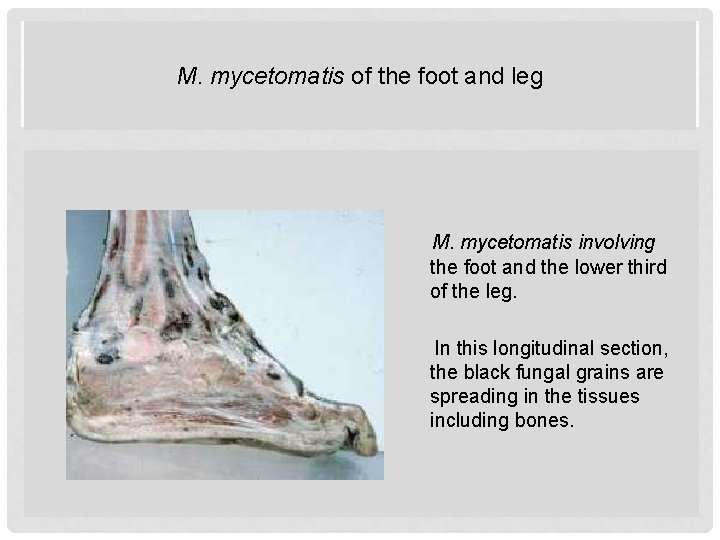 M. mycetomatis of the foot and leg M. mycetomatis involving the foot and the