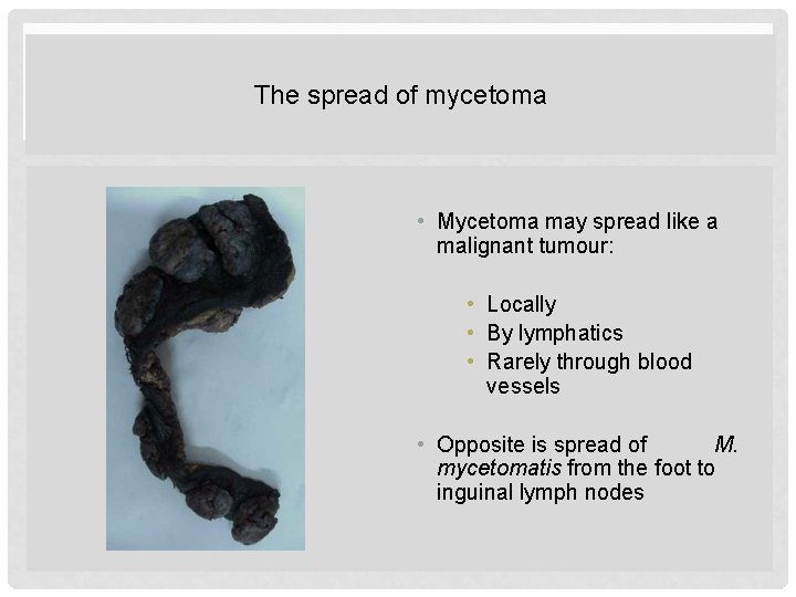 The spread of mycetoma • Mycetoma may spread like a malignant tumour: • Locally