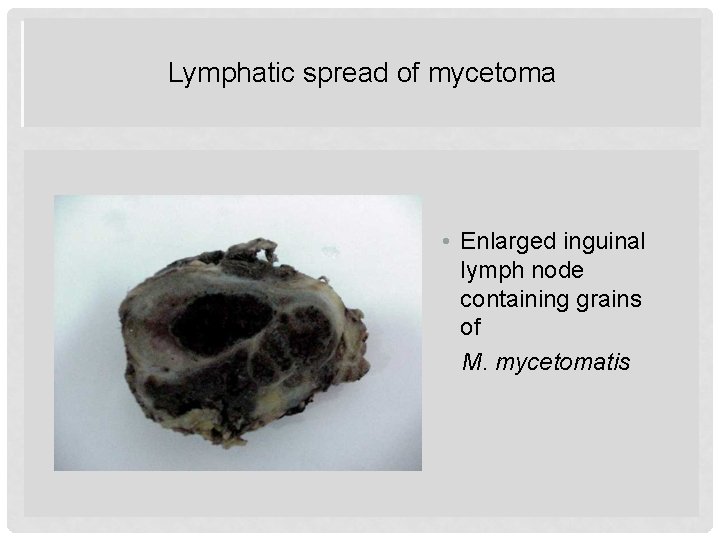 Lymphatic spread of mycetoma • Enlarged inguinal lymph node containing grains of M. mycetomatis