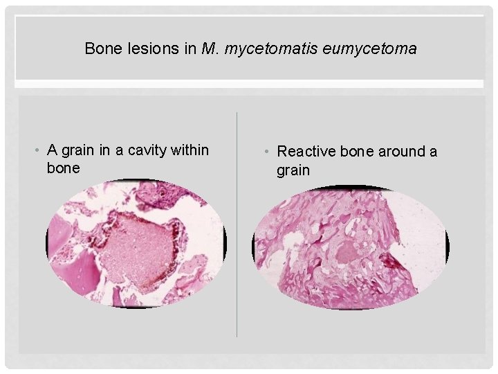 Bone lesions in M. IN mycetomatis eumycetoma BONE LESIONS M MYCETOMATIS • A grain