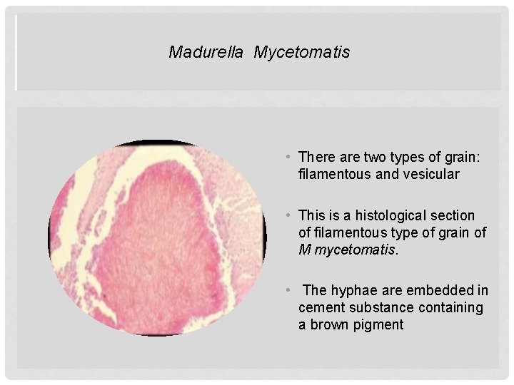 Madurella. MYCETOMATIS Mycetomatis MADURELLA • There are two types of grain: filamentous and vesicular