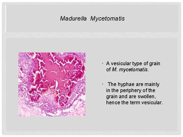 Madurella. MYCETOMATIS Mycetomatis MADURELLA • A vesicular type of grain of M. mycetomatis. •