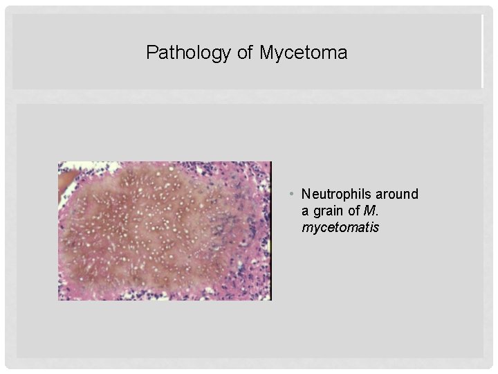 Pathology of Mycetoma PATHOLOGY OF MYCETOMA • Neutrophils around a grain of M. mycetomatis