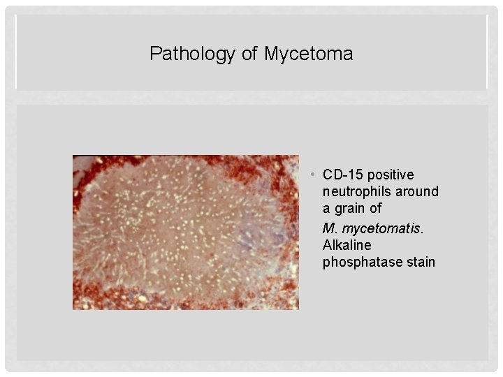 Pathology of Mycetoma PATHOLOGY OF MYCETOMA • CD-15 positive neutrophils around a grain of