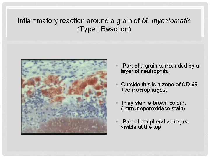 Inflammatory reaction around a grain of M. mycetomatis (Type I Reaction) • Part of