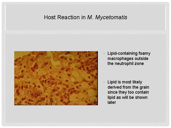 Host Reaction in M. Mycetomatis HOST REACTION IN M MYCETOMATIS • Lipid-containing foamy macrophages