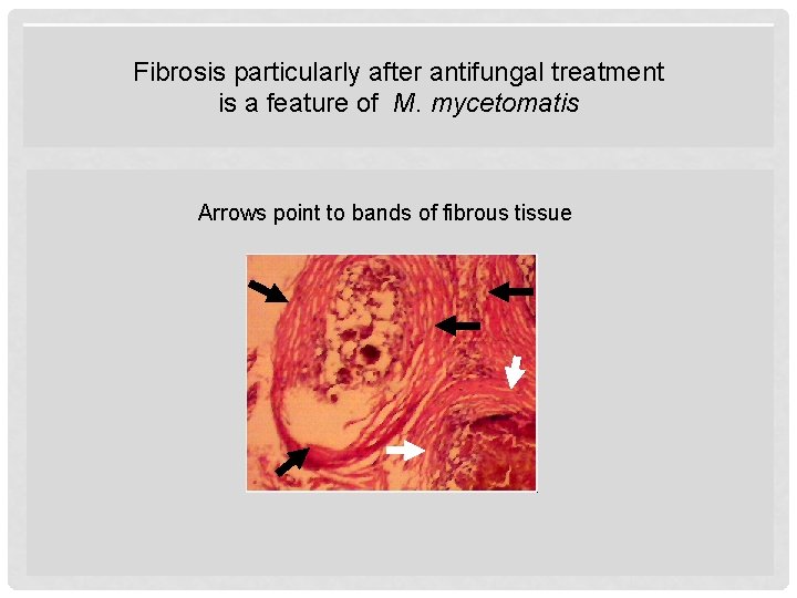 Fibrosis particularly after antifungal treatment is a feature of M. mycetomatis Arrows point to