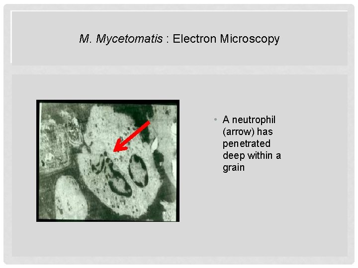 M. Mycetomatis : Electron Microscopy • A neutrophil (arrow) has penetrated deep within a