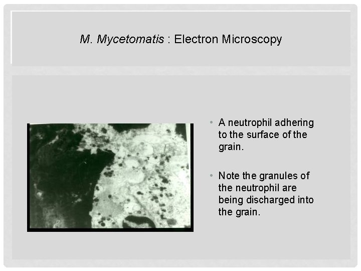 M. Mycetomatis : Electron Microscopy • A neutrophil adhering to the surface of the