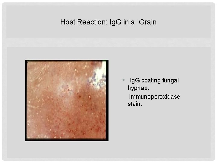 Host Reaction: Ig. G in a Grain • Ig. G coating fungal hyphae. Immunoperoxidase