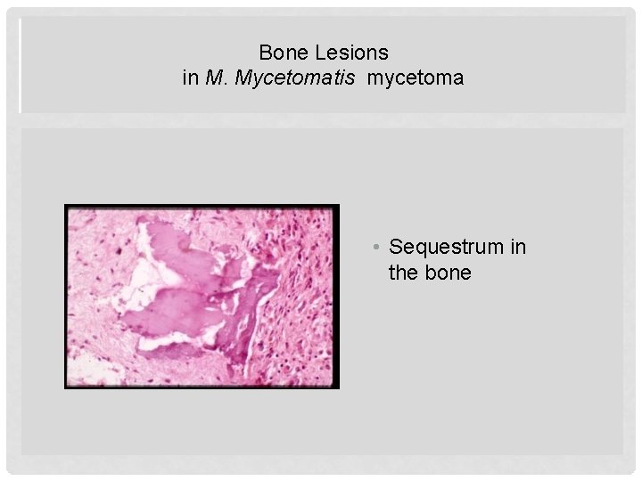 Bone Lesions in M. Mycetomatis mycetoma BONE LESIONS IN M MYCETOMATIS • Sequestrum in