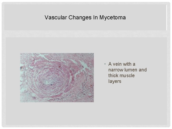 Vascular Changes In Mycetoma VASCULAR CHANGES IN MYCETOMA • A vein with a narrow