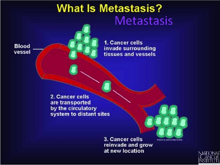 Metastasis 