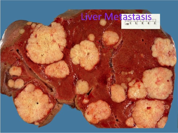 Liver Metastasis 