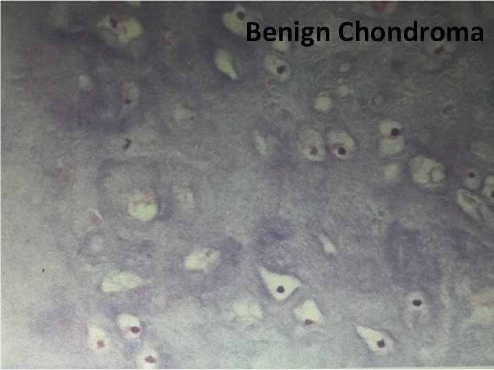 Benign Chondroma 