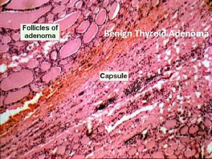 Benign Thyroid Adenoma 