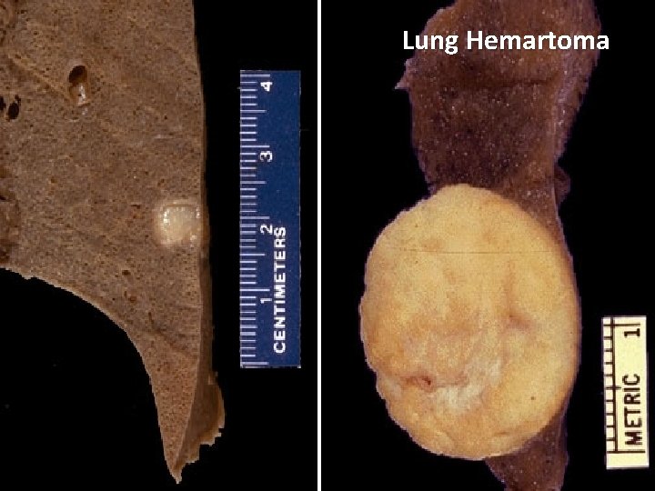 Lung Hemartoma 