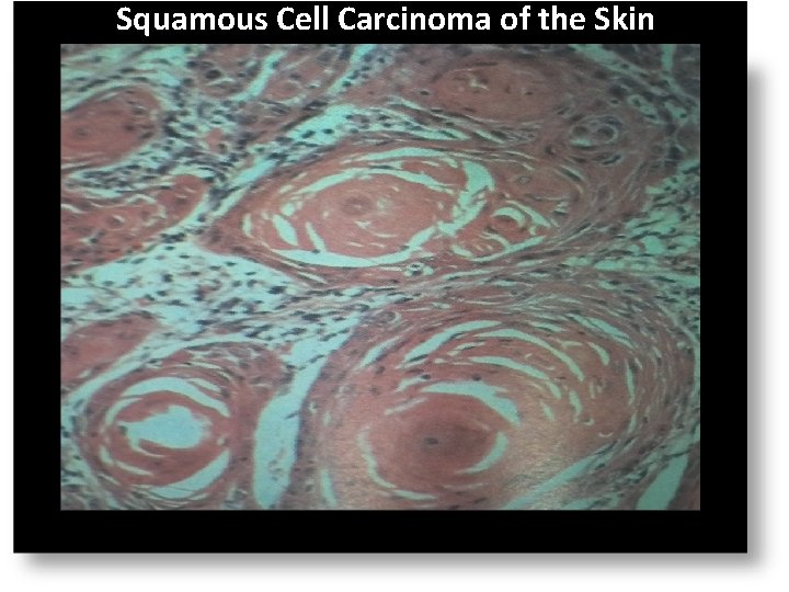 Squamous Cell Carcinoma of the Skin 