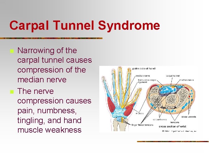 Carpal Tunnel Syndrome n n Narrowing of the carpal tunnel causes compression of the