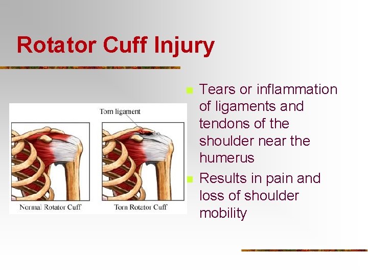Rotator Cuff Injury n n Tears or inflammation of ligaments and tendons of the