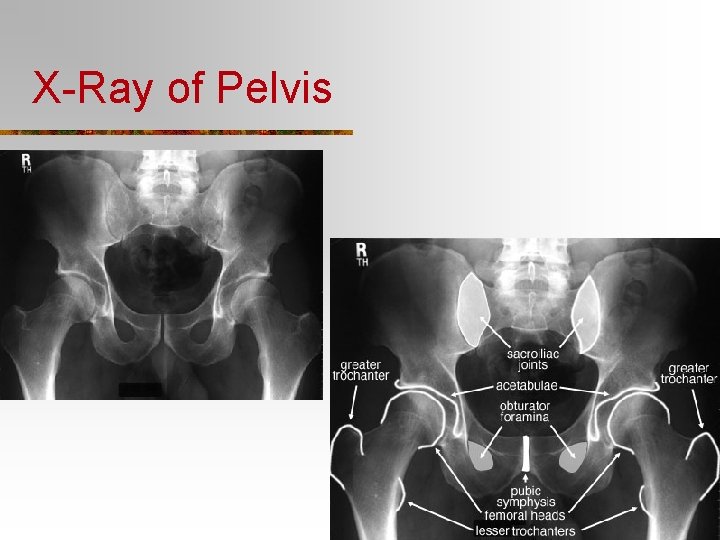 X-Ray of Pelvis 