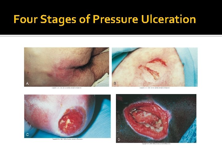 Four Stages of Pressure Ulceration Four Stages of Pressure Ulceration