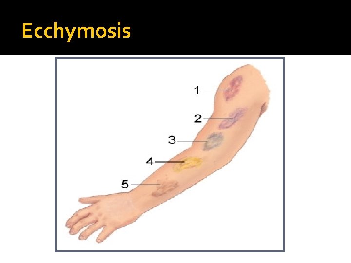 Ecchymosis Ecchymosis