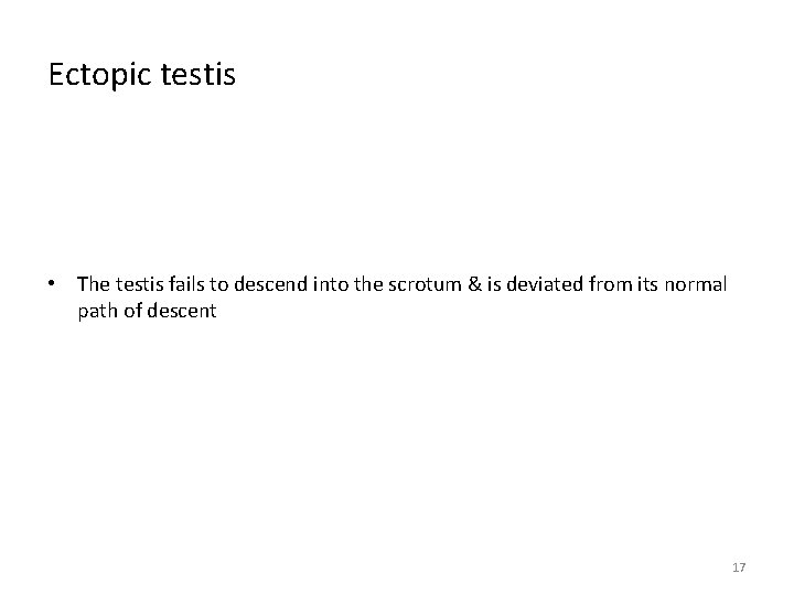 Ectopic testis • The testis fails to descend into the scrotum & is deviated