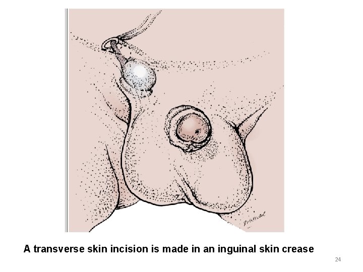 A transverse skin incision is made in an inguinal skin crease 24 