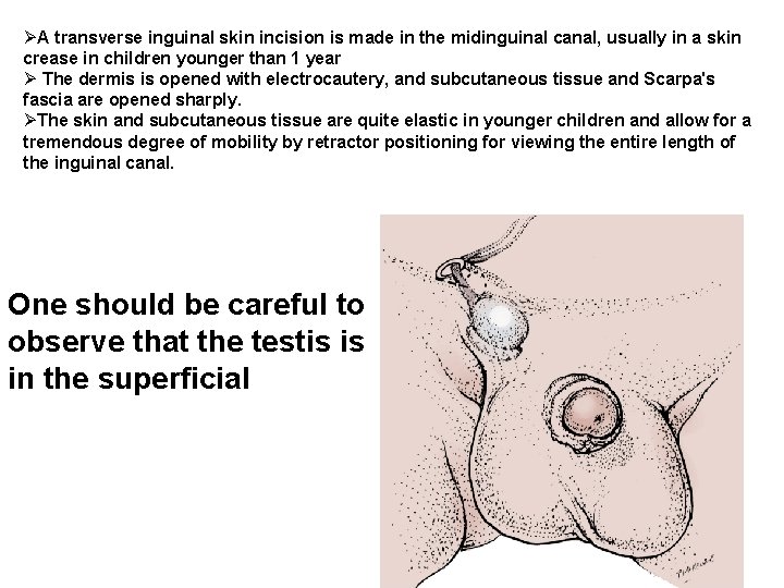 ØA transverse inguinal skin incision is made in the midinguinal canal, usually in a