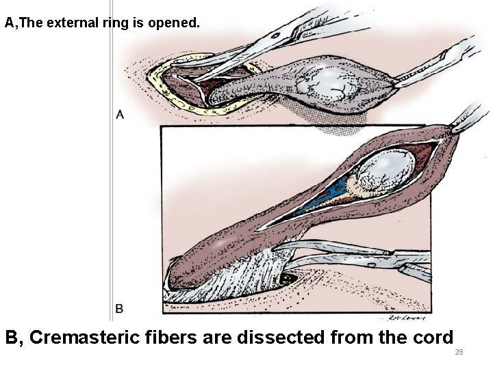 A, The external ring is opened. B, Cremasteric fibers are dissected from the cord