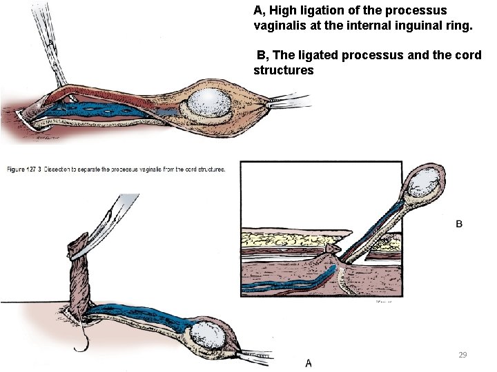 A, High ligation of the processus vaginalis at the internal inguinal ring. B, The